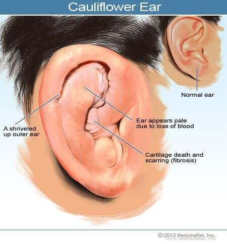 &quot;Penampakan&quot; ANEH di Telinga Para Petarung MMA?itu Adalah CAULIFLOWER EARS Gan!