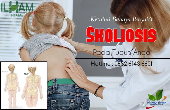 Penyakit Skoliosis Mengancam Nyawa? Ketahui Dengan Jelas!