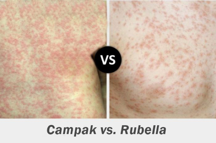 Bilangin Sama Saudara atau Tetangga, Jangan lupa untuk Vaksin Campak & Rubella