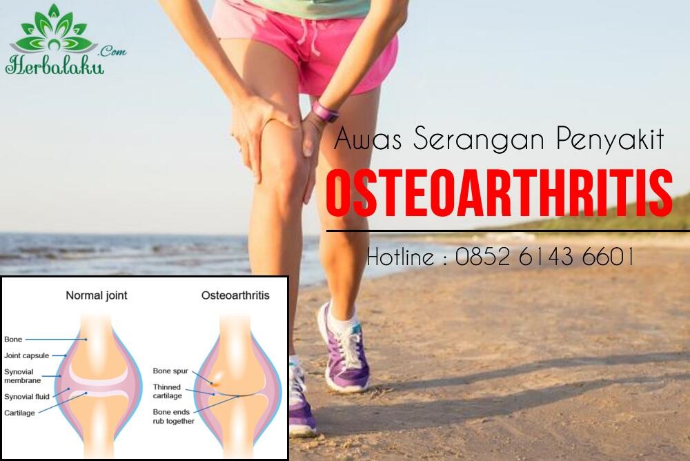 Hati-hati! Penyakit Osteoarthritis Menyebabkan Kelumpuhan