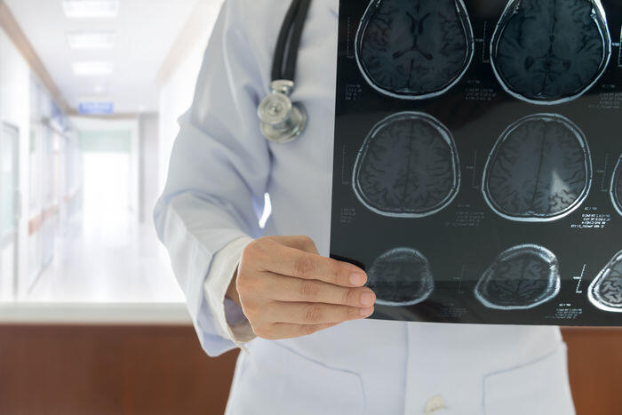 Cirebon waspada stroke sebagai penyakit mematikan nomor dua