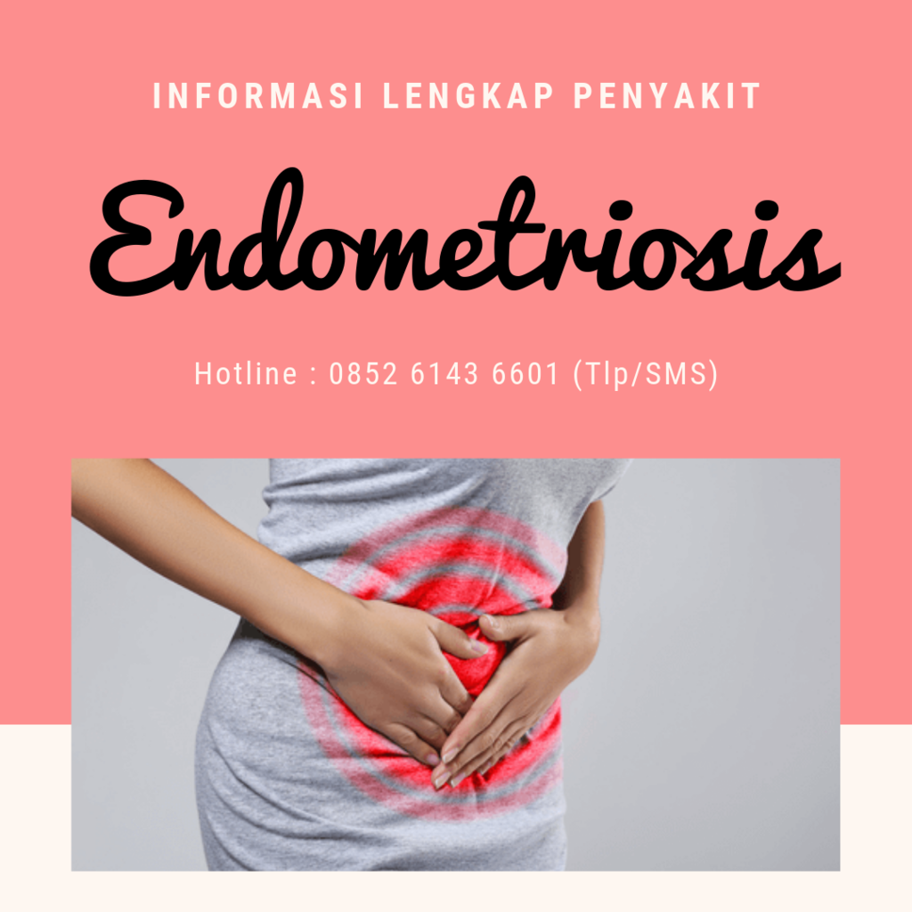 Waspada! Penyakit Endometriosis Sebabkan Kemandulan