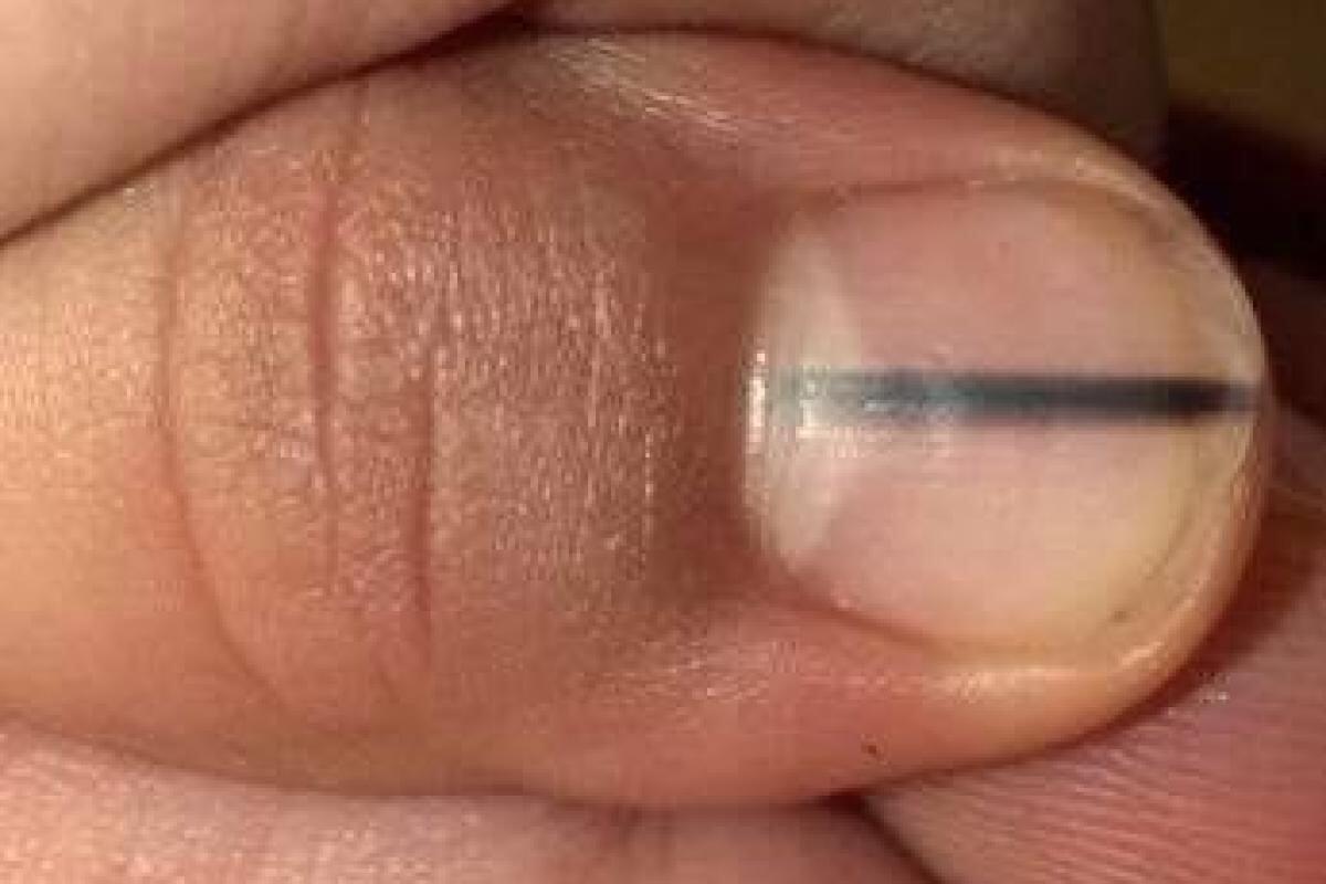 8 Kondisi Kuku ini Bakal Menggambarkan Bagaimana Keadaan Kesehatanmu