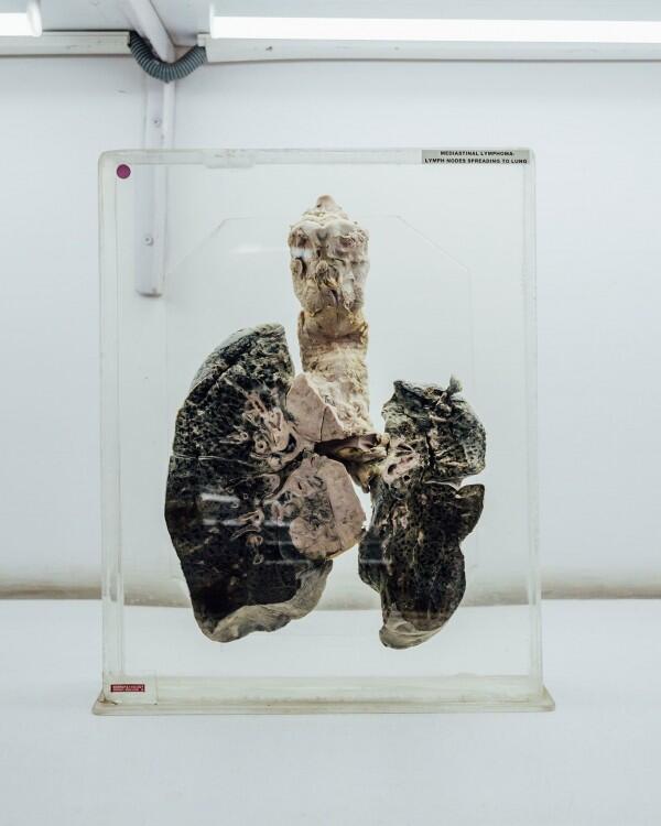 Total Ada 600 Otak Manusia di Brain Museum, Ini 8 Fakta Uniknya!