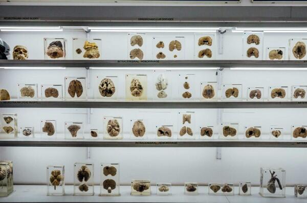 Total Ada 600 Otak Manusia di Brain Museum, Ini 8 Fakta Uniknya!