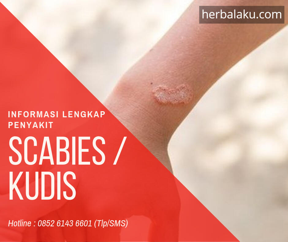 Scabies - Penyakit Kulit Yang Sangat Mudah Menular