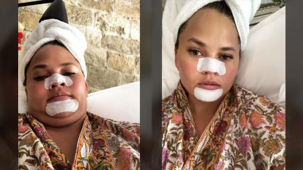 Apakah Pore Strips Benar-benar Bisa Menghilangkan Komedo?