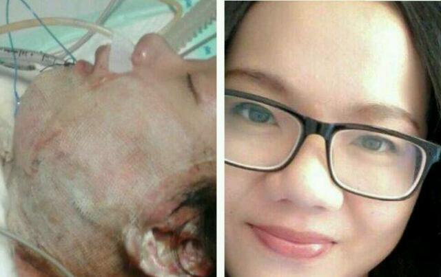 Butuh Doa & Biaya, Seperti ini Kondisi Mahasiswi yang Dibakar Mantan Pacarnya