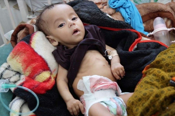 Akibat Perang di Yaman, 85 Ribu Anak Meninggal Karena Malnutrisi
