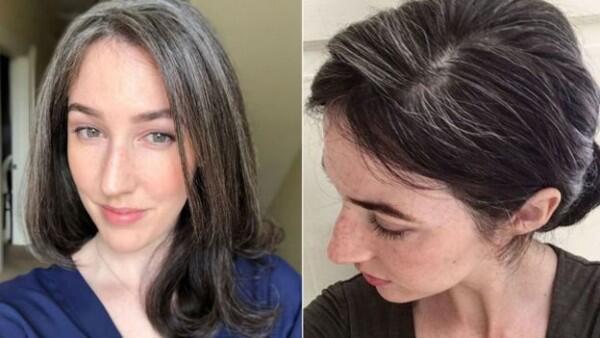 5 Masalah Rambut yang Mengintai Kalau Kamu Gampang Stres