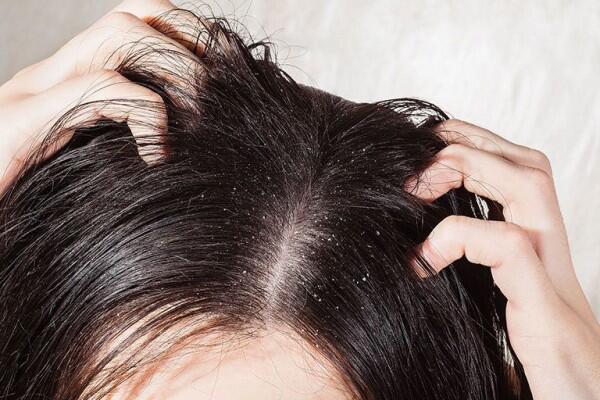 5 Masalah Rambut yang Mengintai Kalau Kamu Gampang Stres
