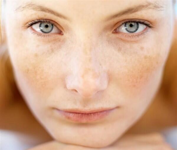 5 Beda Sun Spot vs. Dark Spot yang Harus Kamu Tahu, Jangan Ditukar Ya!