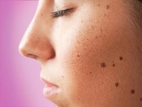 5 Beda Sun Spot vs. Dark Spot yang Harus Kamu Tahu, Jangan Ditukar Ya!