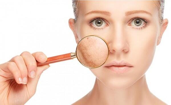 5 Beda Sun Spot vs. Dark Spot yang Harus Kamu Tahu, Jangan Ditukar Ya!