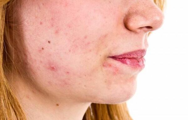 5 Akibat yang Akan Diterima Jika Gunakan Berbagai Macam Skincare!
