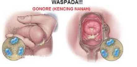 Infeksi Dan Perawatan Gonore