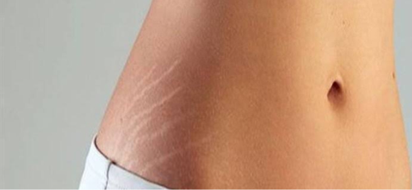 Cara Ampuh Buat Kulit Mulus Bebas Stretch Mark