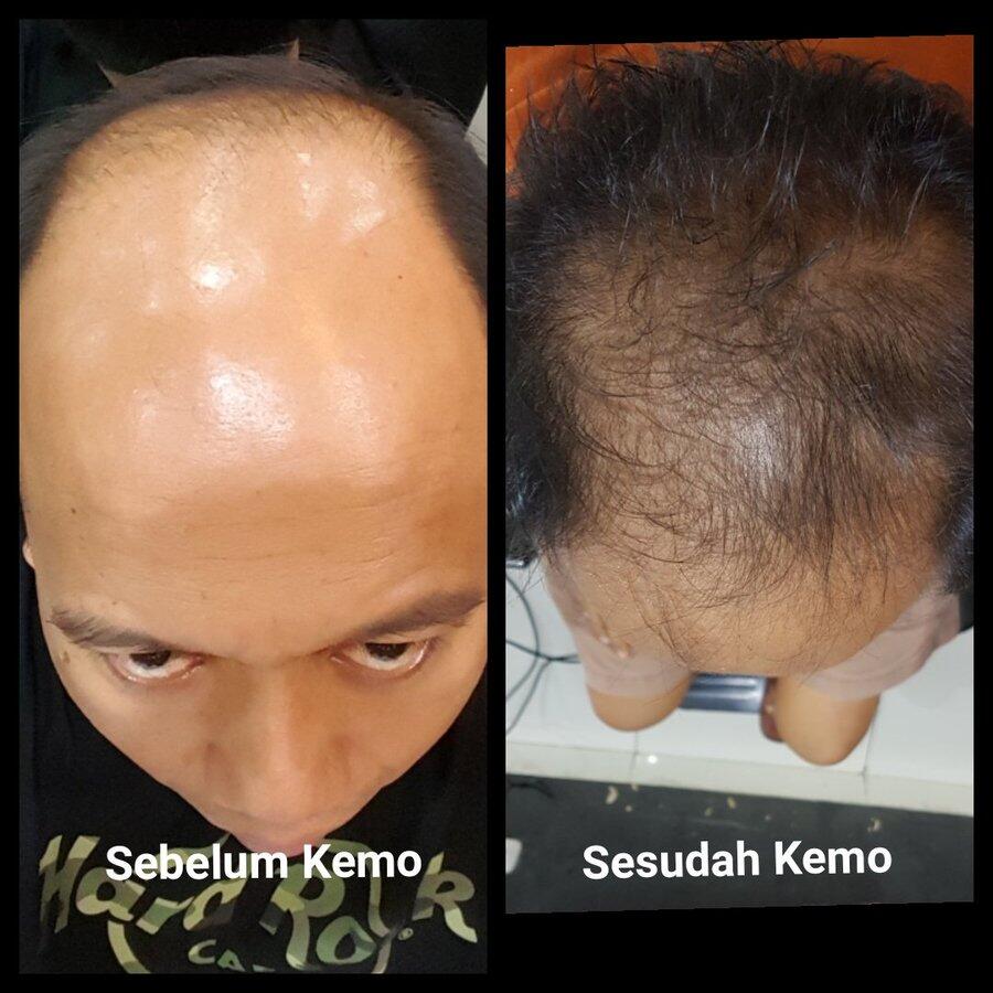 Usai Kemoterapi, Rambut Sutopo Malah Tumbuh, Kok Bisa?