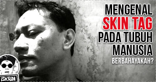 Mengenal Skin Tag, Benjolan Selain Tahi Lalat yang Tidak Berbahaya?