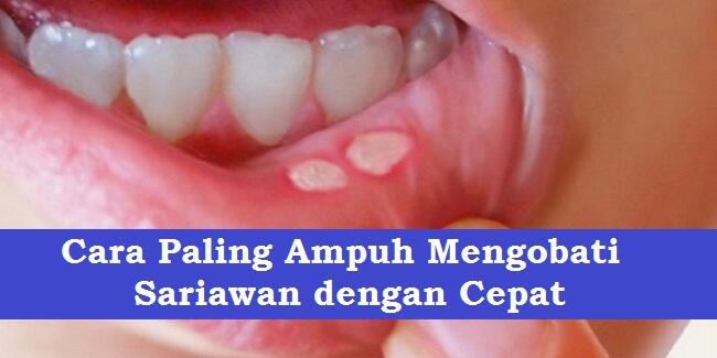 Cara Paling Ampuh Mengobati Sariawan dengan Cepat
