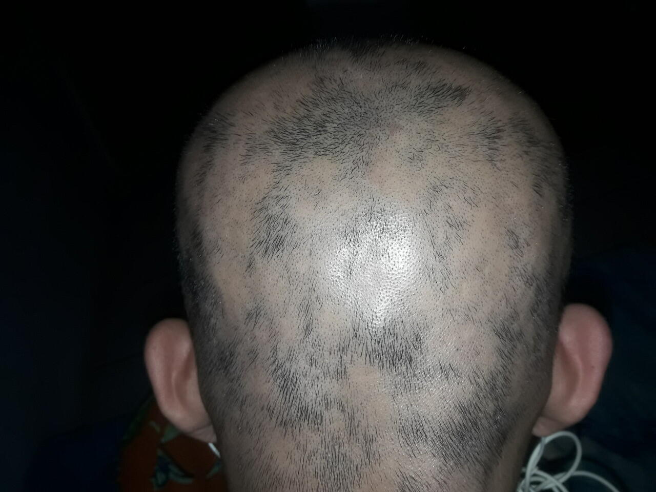 Alopecia Areata Kaskus