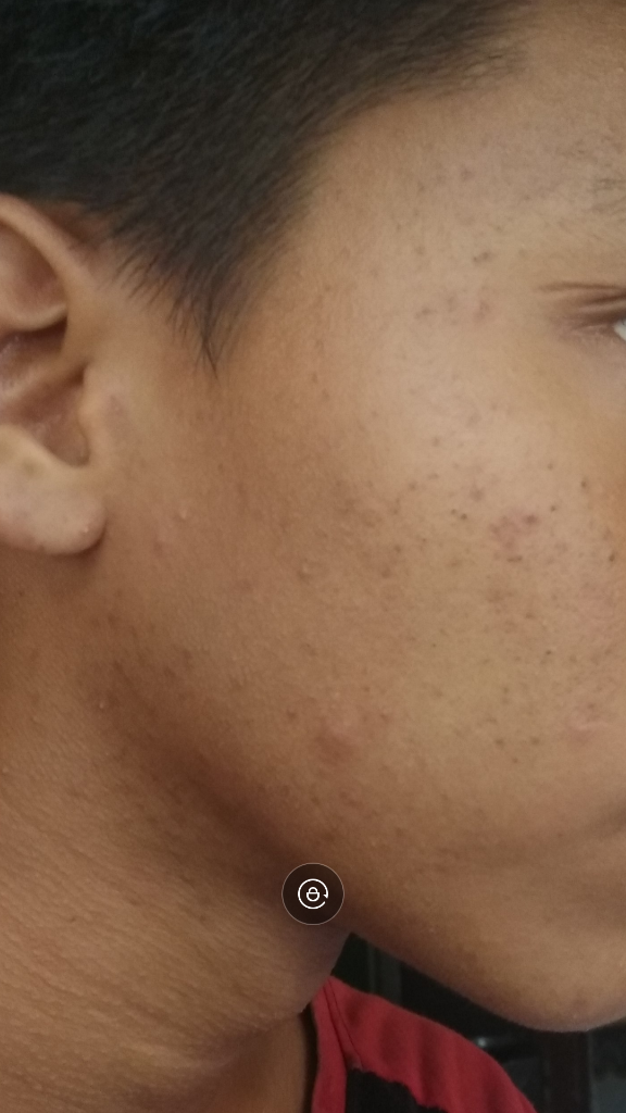 Jerawat Bekas Jerawat Komedo | KASKUS