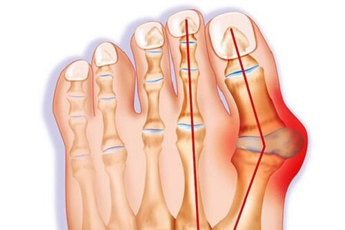 Kakimu Mengalami Bunion? Ini Cara Mengatasinya Loh!