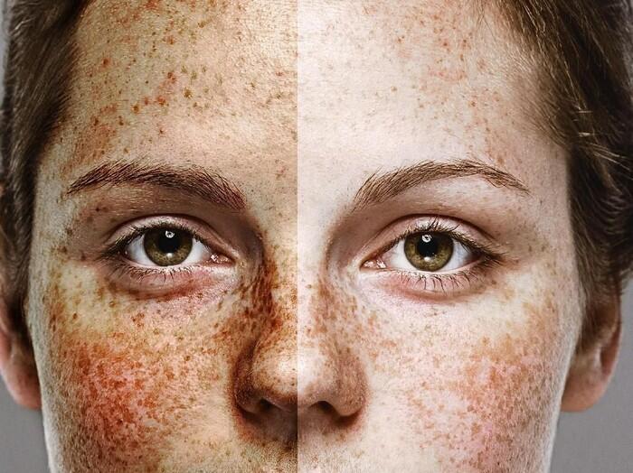 Hati Hati! Konsumsi Narkoba Bisa Memperburuk Kondisi Wajahmu!