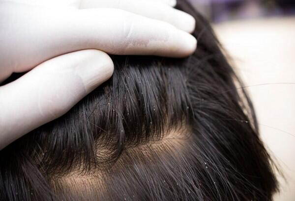 5 Manfaat Hebat Minyak Wijen untuk Rambut, Sudah Pernah Coba?