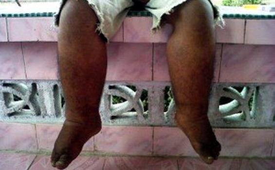 Penyakit Kaki Gajah Dapat Ditularkan Melalui Semua Jenis Nyamuk