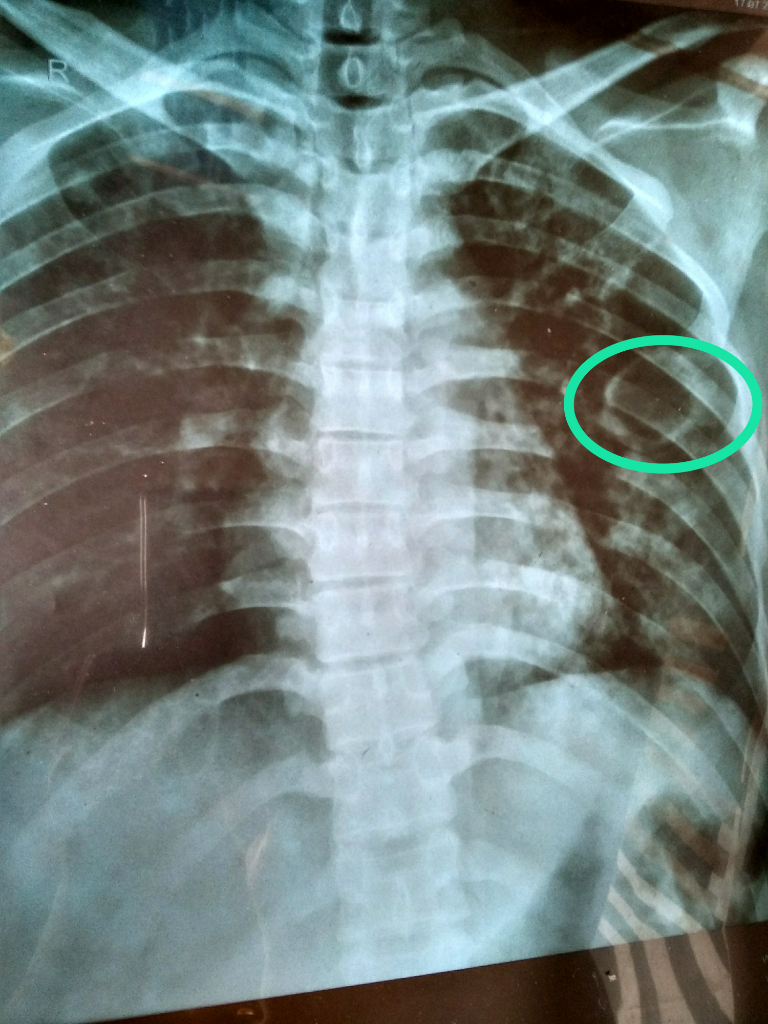 Waspada TB ( Tuberculosis )