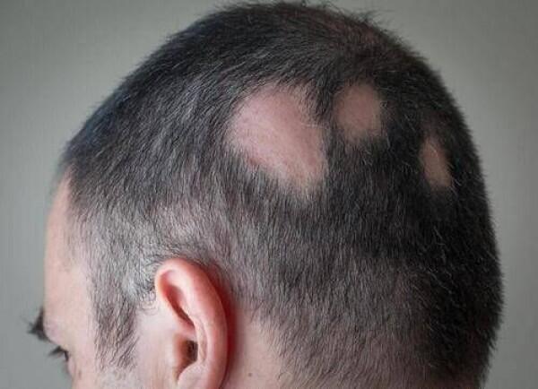 Gak Semuanya Sama, Ini 6 Jenis Rambut Rontok dan Penyebabnya