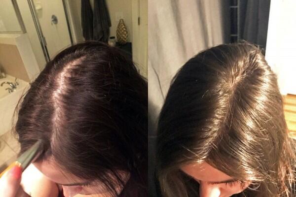 Gak Semuanya Sama, Ini 6 Jenis Rambut Rontok dan Penyebabnya