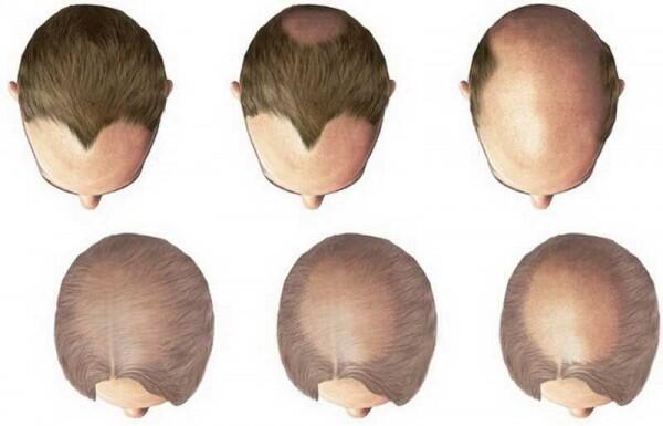 Gak Semuanya Sama, Ini 6 Jenis Rambut Rontok dan Penyebabnya