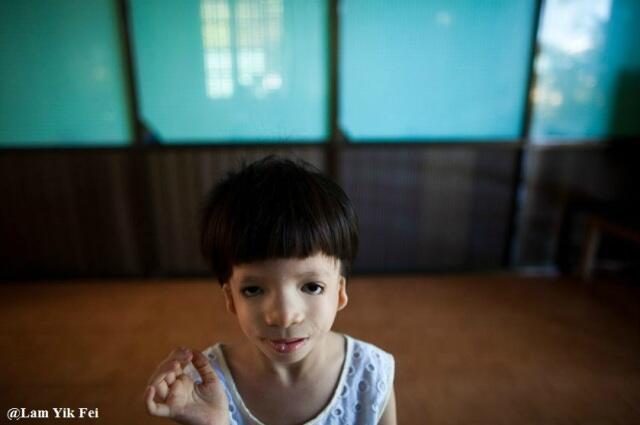 Foto Anak-Anak Korban Agent Orange Di Vietnam