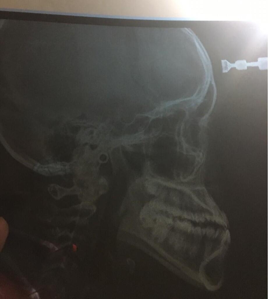 Cara Rapihkan Gigi Underbite (Cameuh/Cakil)