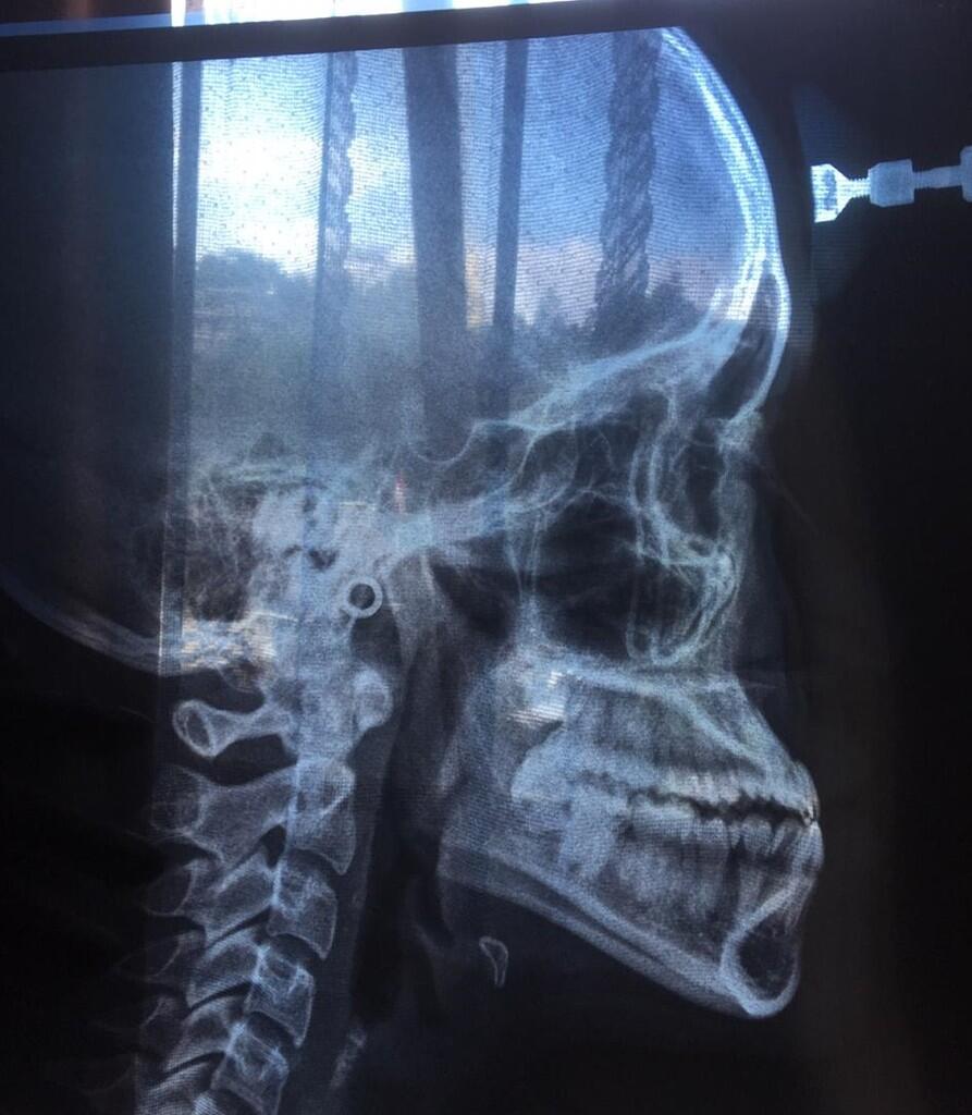 Cara Rapihkan Gigi Underbite (Cameuh/Cakil)