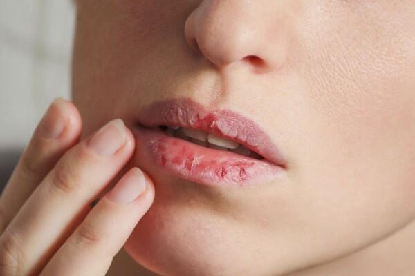 5 Tips Atasi Bibir Kering & Pecah-pecah Selama Puasa