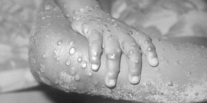 Pemerintah Minta Masyarakat Waspada Cacar Monyet