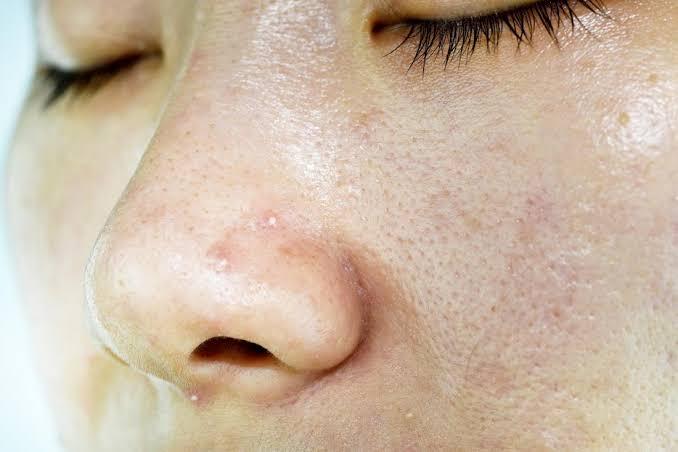 Punya Kulit Wajah Berminyak? Coba Atasi Dengan Tips Berikut