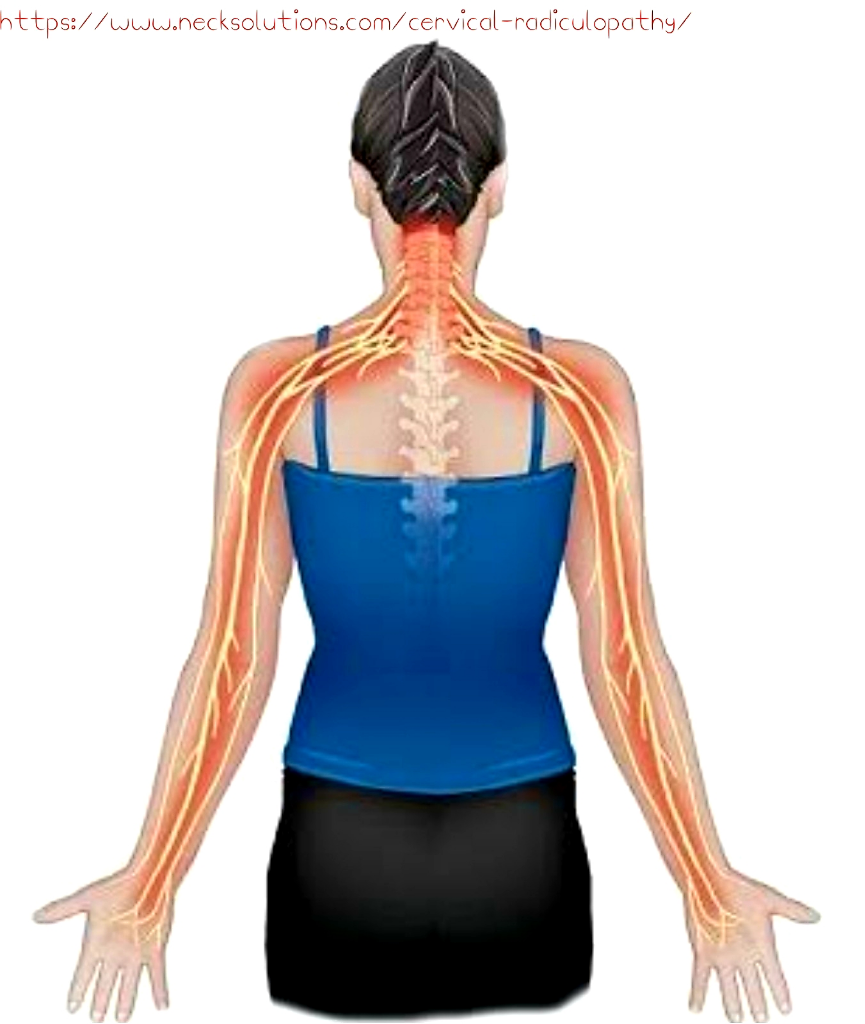 SPONDYLOSIS CERVICAL, Kemungkinan Penyebab Sakit Leher dan Kesemutan di Tangan
