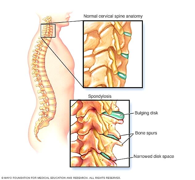 SPONDYLOSIS CERVICAL, Kemungkinan Penyebab Sakit Leher dan Kesemutan di Tangan