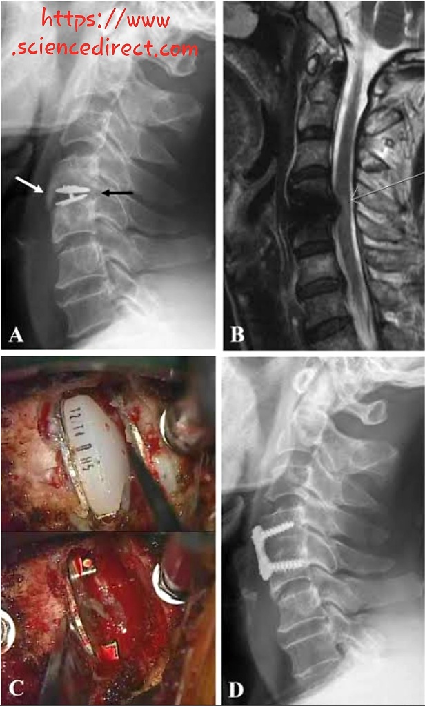 SPONDYLOSIS CERVICAL, Kemungkinan Penyebab Sakit Leher dan Kesemutan di Tangan