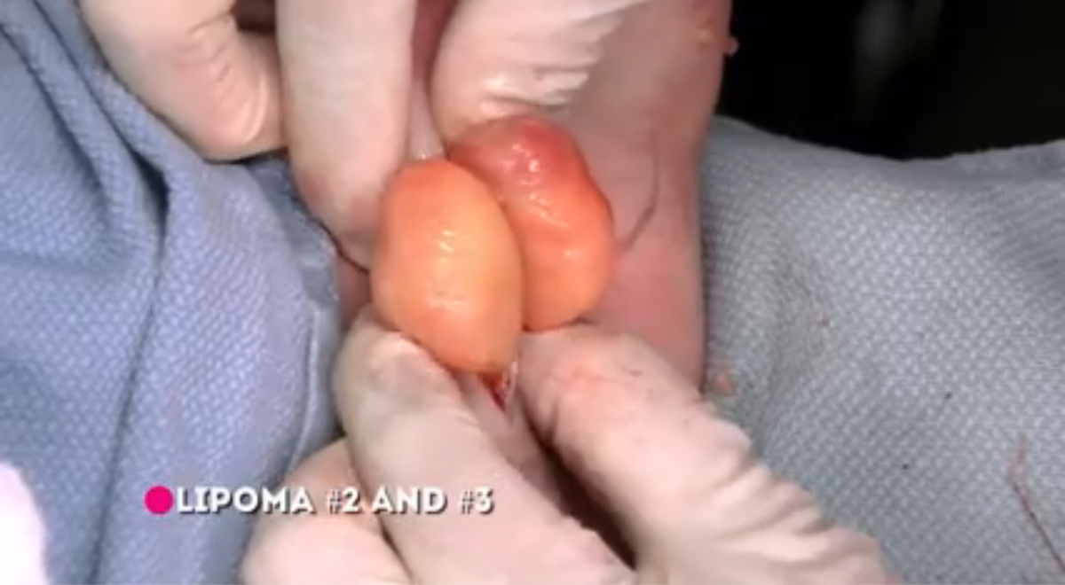 Apa itu Lipoma (dilengkapi data, foto & video).. keliatan thread niat banget