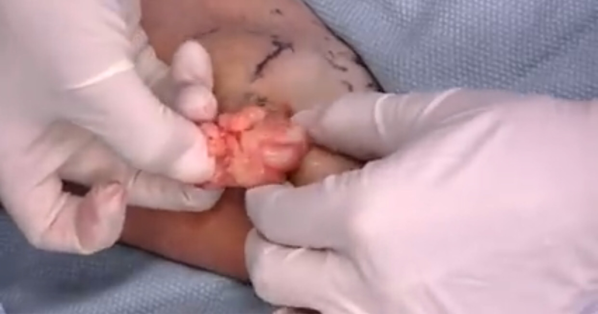 Apa itu Lipoma (dilengkapi data, foto & video).. keliatan thread niat banget