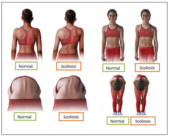 Aktris Cuuuantik Shailene Woodley dgn Scoliosis (Tulang Bengkok) Semangat &amp; Bersyukur