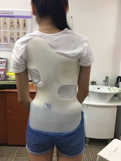 Aktris Cuuuantik Shailene Woodley dgn Scoliosis (Tulang Bengkok) Semangat &amp; Bersyukur