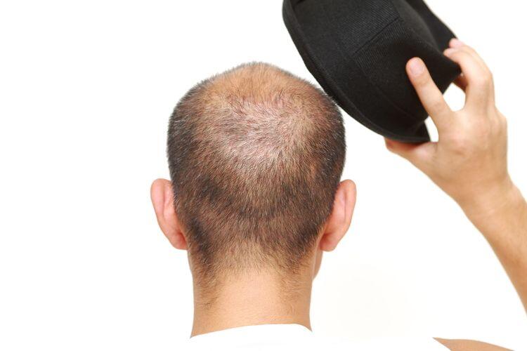 Sering Pakai Topi Bisa Bikin Botak, Benarkah?