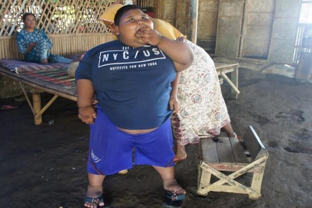 Obesitas, Bocah 7 Tahun di Karawang Beratnya Tembus 97 Kilogram