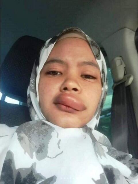 Lupa Pakai Masker Saat Naik Motor! Bibir Wanita Ini di Gigit Serangga Sampai Bengkak